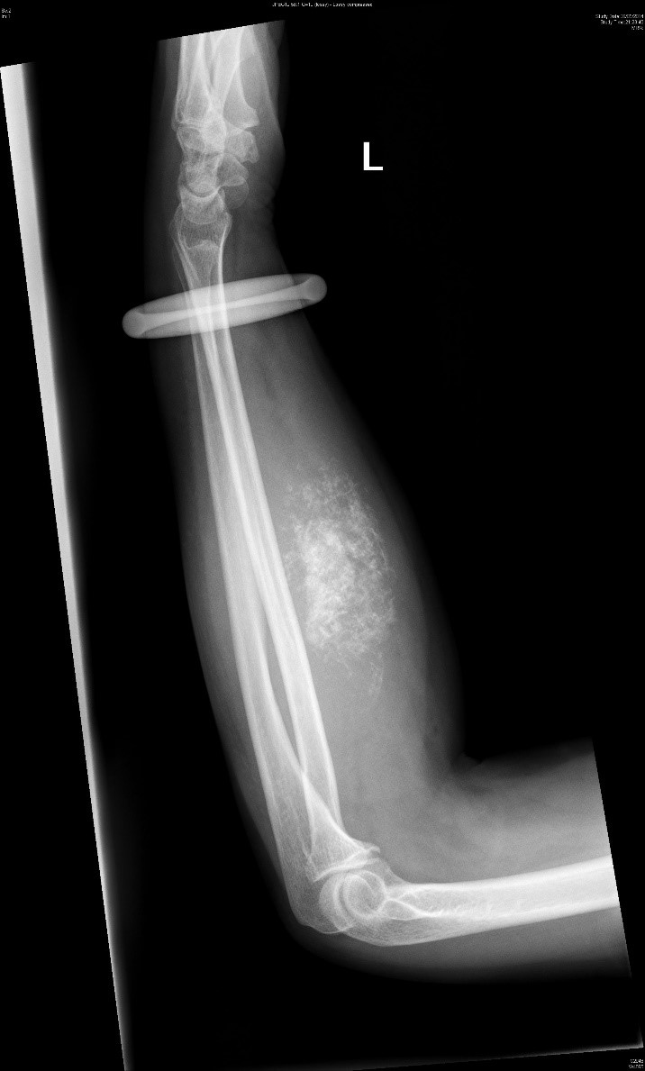 Figure 1. Plain XR Left Forearm (Lateral)